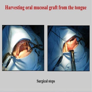 Harvesting oral tongue mucosa