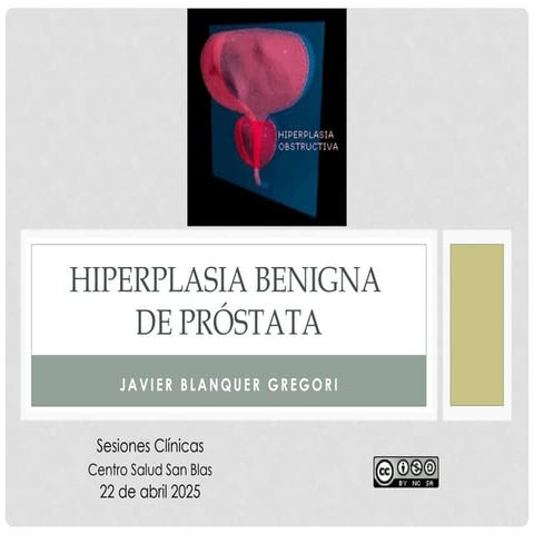 HBP Obstrucción Prostática Benigna Actualización REvisión bibliográfica