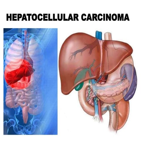 Hepatocellular Carcinoma- At a Glance | PPT