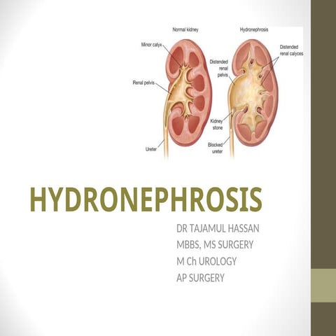 HDN hydronephosis etiology and managment .ppt