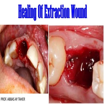 Healing Of Extraction Wound.pdf