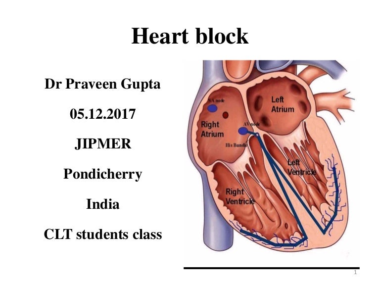 Heart block