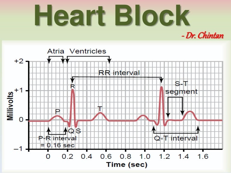 Heart block and ECG