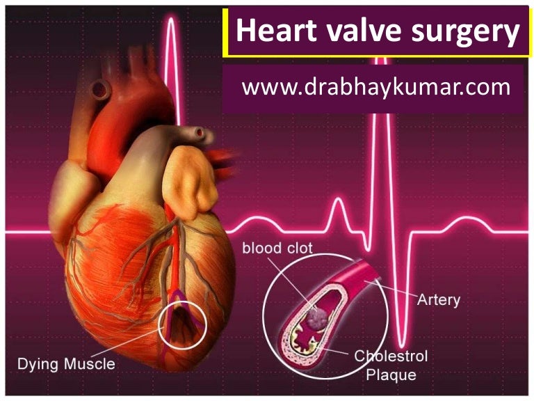 Heart valve surgery in Delhi