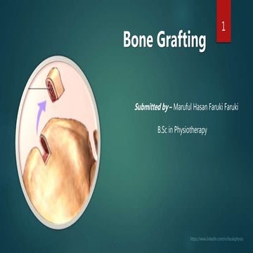 Bone grafting(PT)