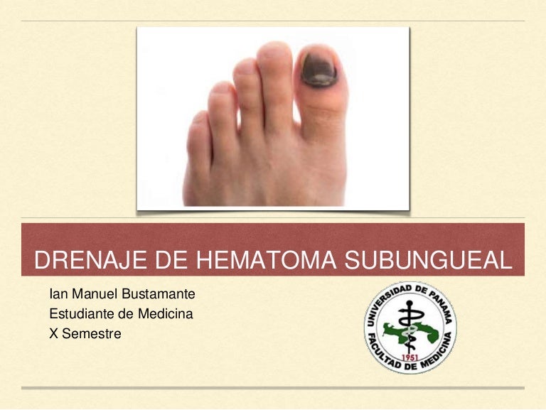 drenar un hematoma subungueal drenar un hematoma subungueal
