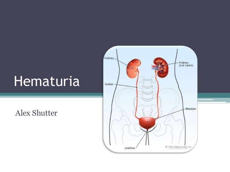 Hematuria