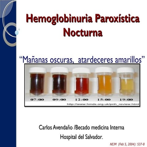 Hemoglobinuria paroxistica nocturna