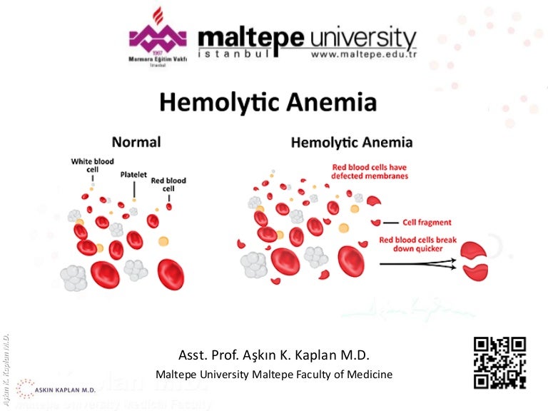 Hemolytic anemia akk