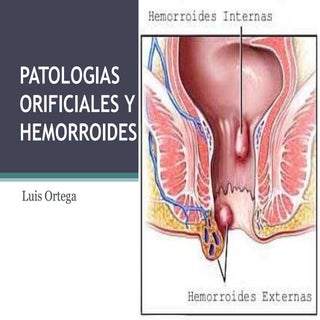 Hemorroides y otras patologias orif...