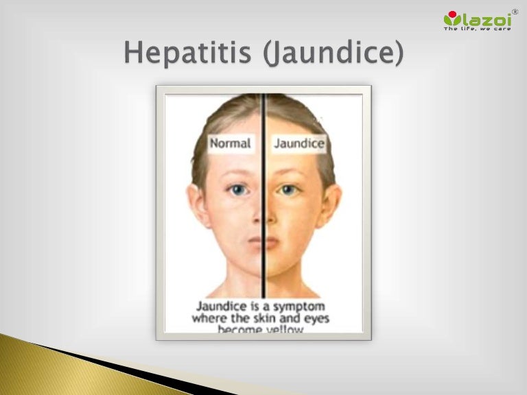 Hepatitis Jaundice