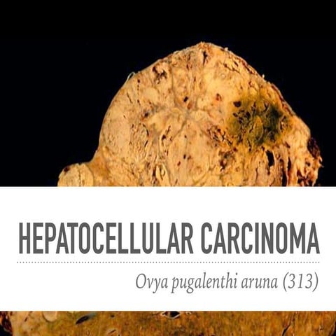 Hepatocellular carcinoma 