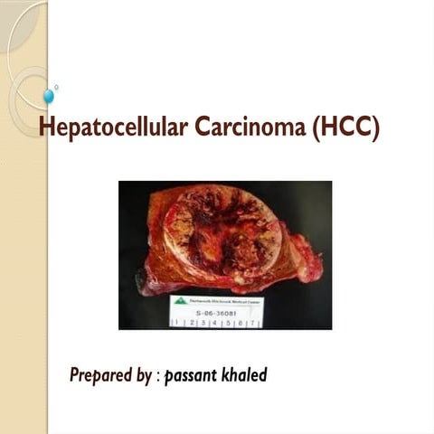 Hepatocellular Carcinoma12212210224242204 | PPTX