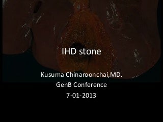 IHD stone