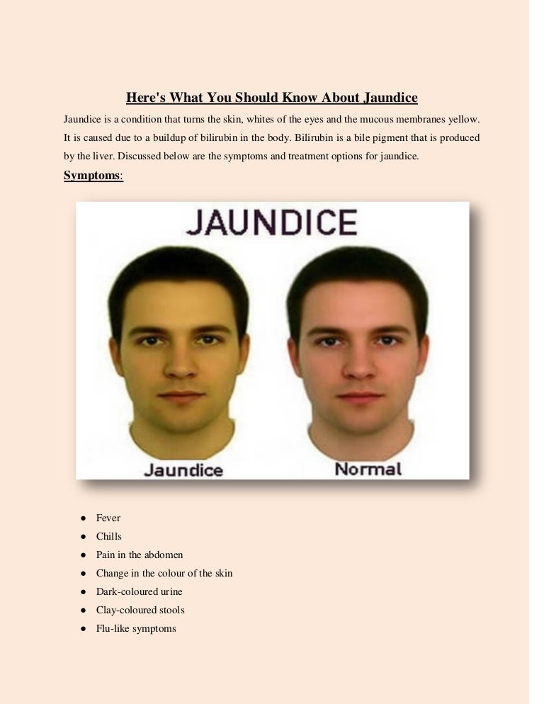 Here's What You Should Know About Jaundice