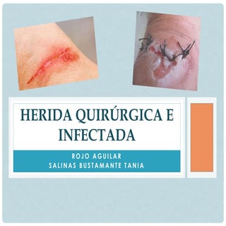 Herida quirúrgica e infectada
