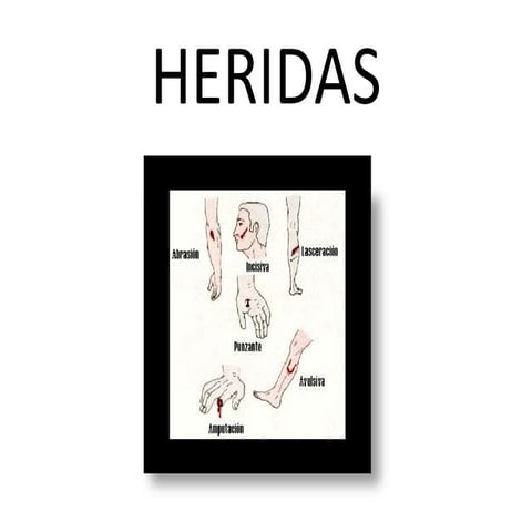 Heridas 