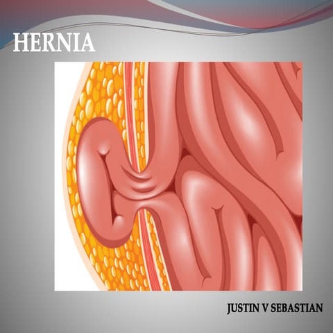 Hernia.pdf