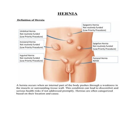 Hernia - Defination, Types, complications , precautions, surgery, procedure