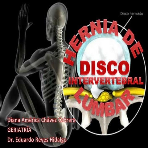 Hernia de disco vertebral