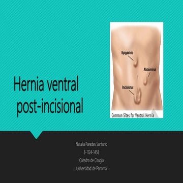 Hernia ventral post incisional | PPTX