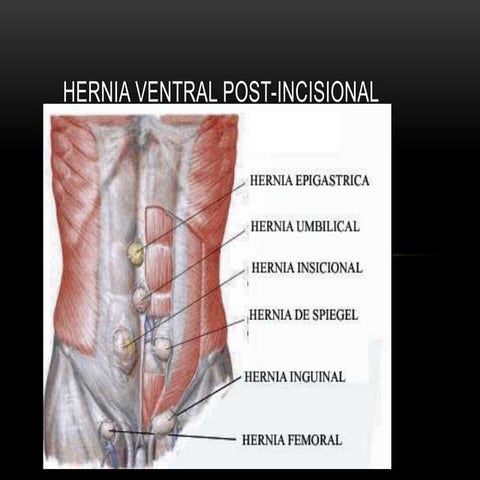 Hernia ventral post incisional | PPTX