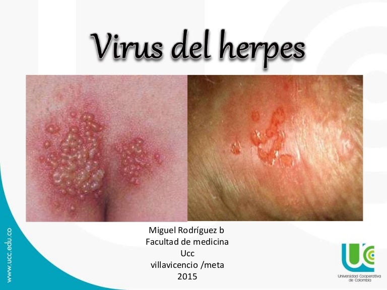 Herpes