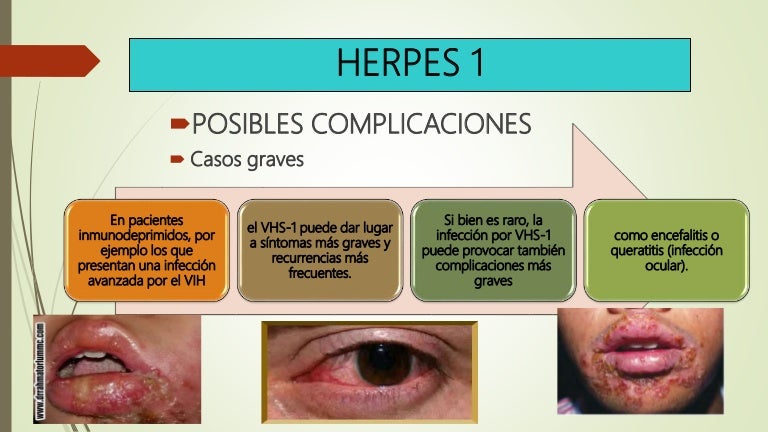 Herpes 1 y 2
