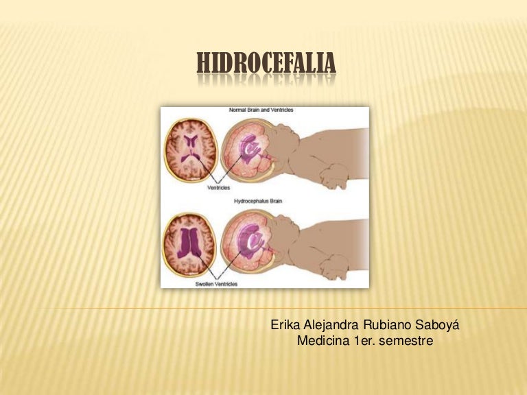 Tratamiento de hidrocefalia por medicina Tratamiento de hidrocefalia por medicina
