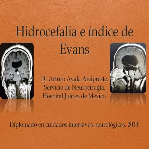 Hidrocefalia e indice de Evans. Arturo Ayala-Arcipreste MD FAANS