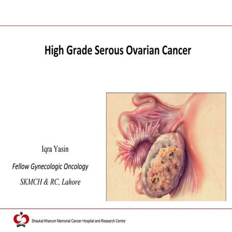 High Grade Serous Ovarian Cancer