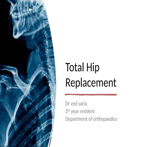 Evolution of Total Hip Replacement | PPT