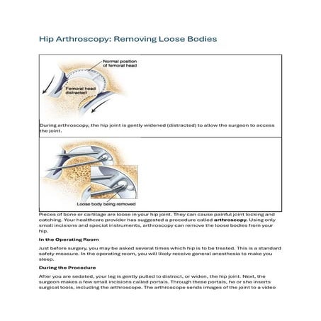 Loose Body Arthroscopy By Dr. Shekhar Srivastav | PDF
