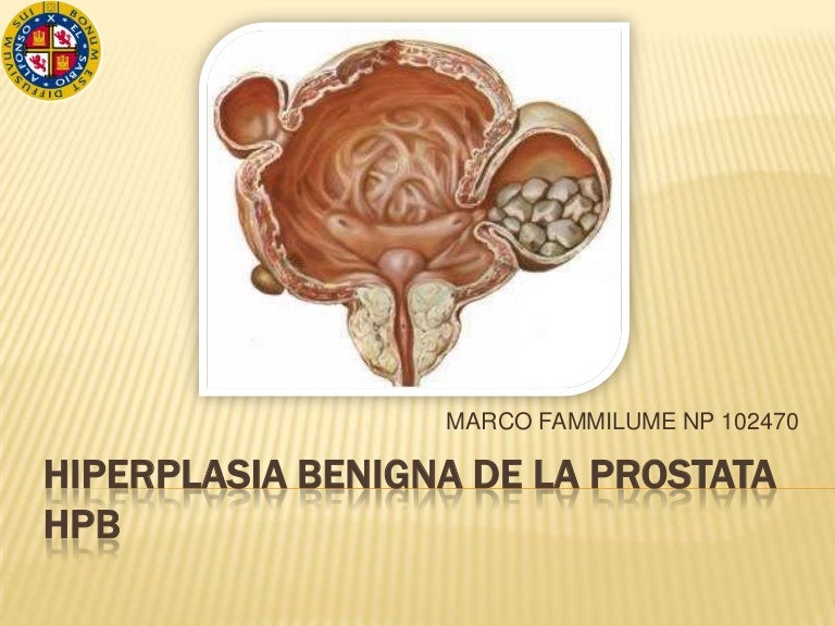 hiperplasia prostatica benigna pdf slideshare