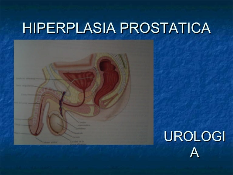 hipertrofia de prostata grado ii/iv
