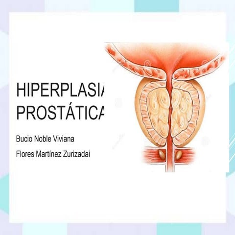 Hiperplasia prostatica.