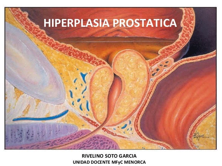 hiperplasia fibroglandular de la próstata