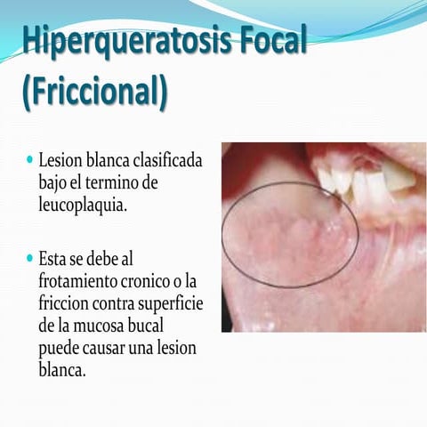 Hiperqueratosis focal (friccional)
