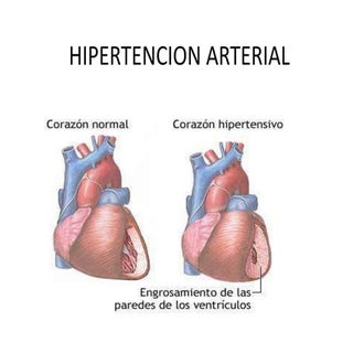 Hipertencion arterial