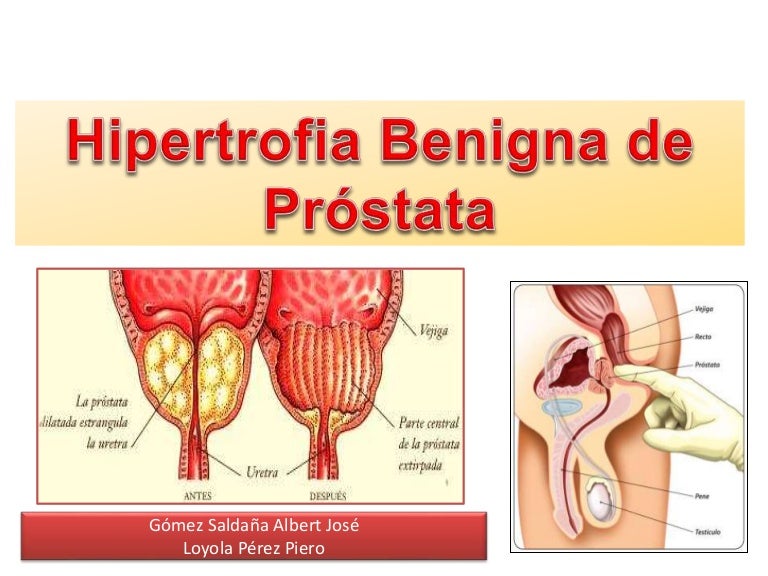 definir hipertrofia de la glándula prostática