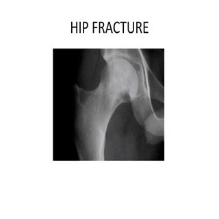 Hip fracture