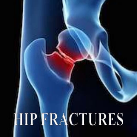 Hip fractures