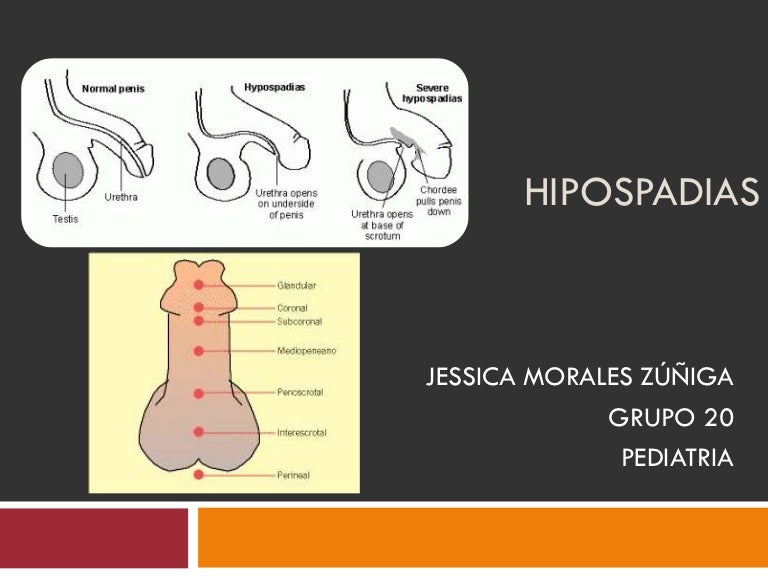 Hipospadias