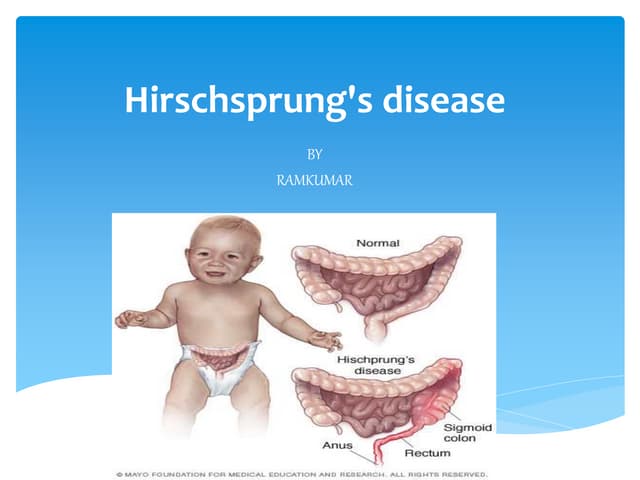 Hirschsprung’s disease