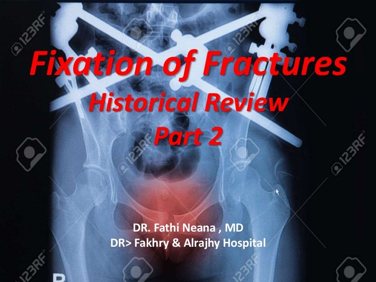History of fracture fixation part 2