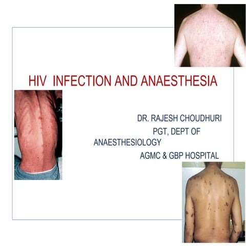 Hiv and anaesthesia