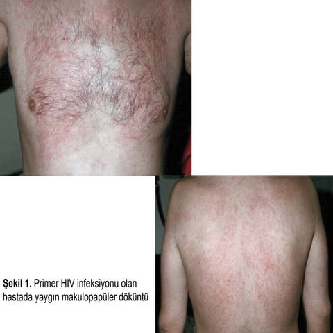 Hiv infeksiyonu (fazlası için www.tipfakultesi.org ) | PDF
