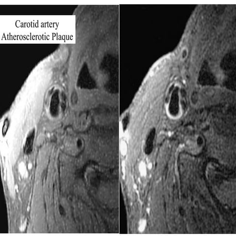 Carotid array coil   3(1)