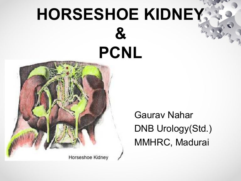 Horseshoe kidney & PCNL