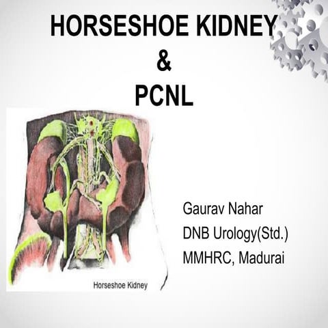 Horseshoe kidney & PCNL